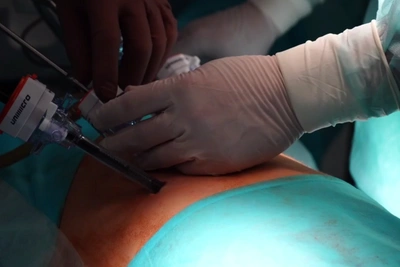 Two Operations at Once: Irkutsk Surgeons Save Child with Rare Blood Disease