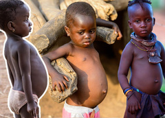 Почему у детей из Африки на самом деле такие большие животы