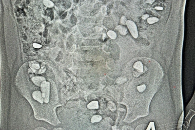 Three-Year-Old in Yessentuki Swallows Over 25 Stones