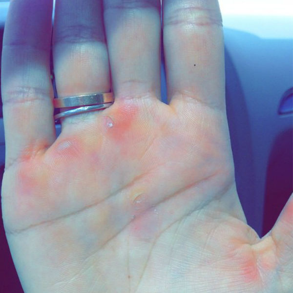 Спортсменка показала в своем микроблоге руки с мозолями от шеста