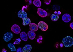 Британская студентка-медик учит женщин определять рак шейки матки дома