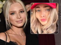 Хирург про новое лицо Алены Шишковой — сделала все, что не надо было