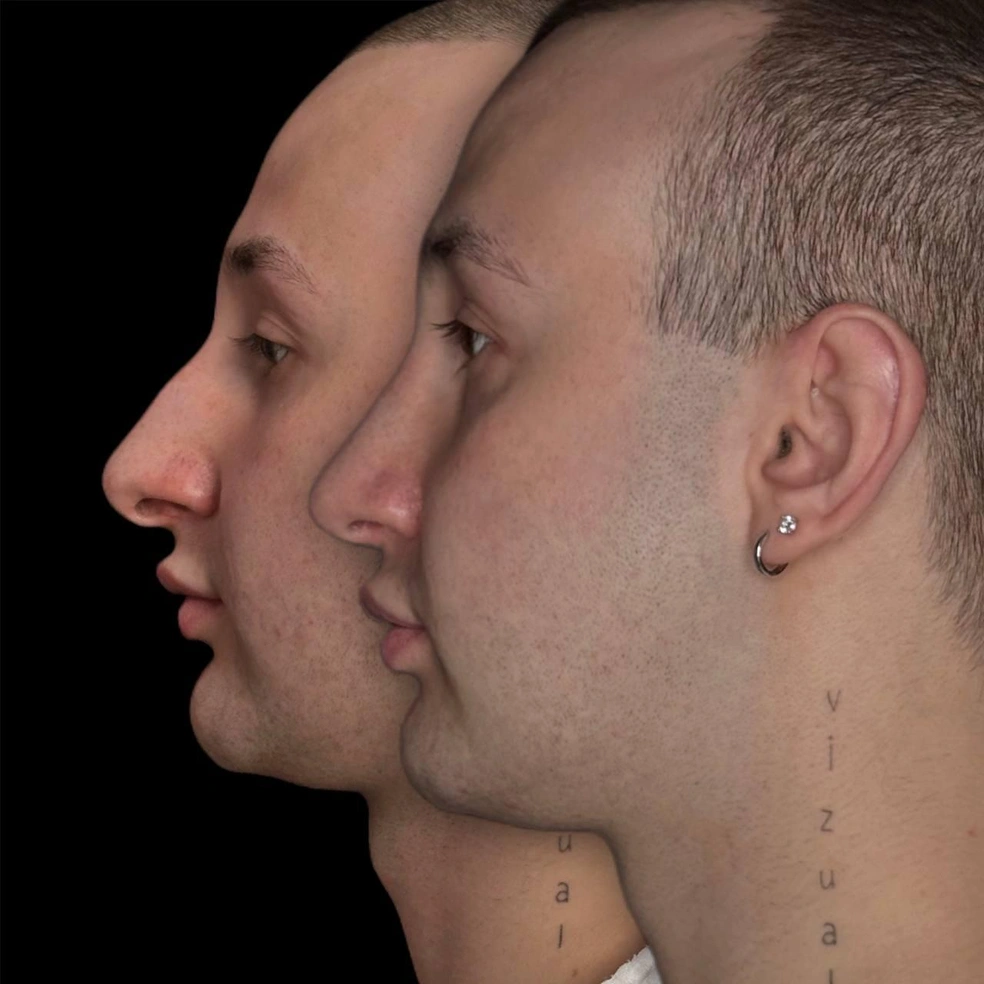 Форму носа он изменил ради своего здоровья, а не эстетики | Источник: sasha.vizual / Instagram*