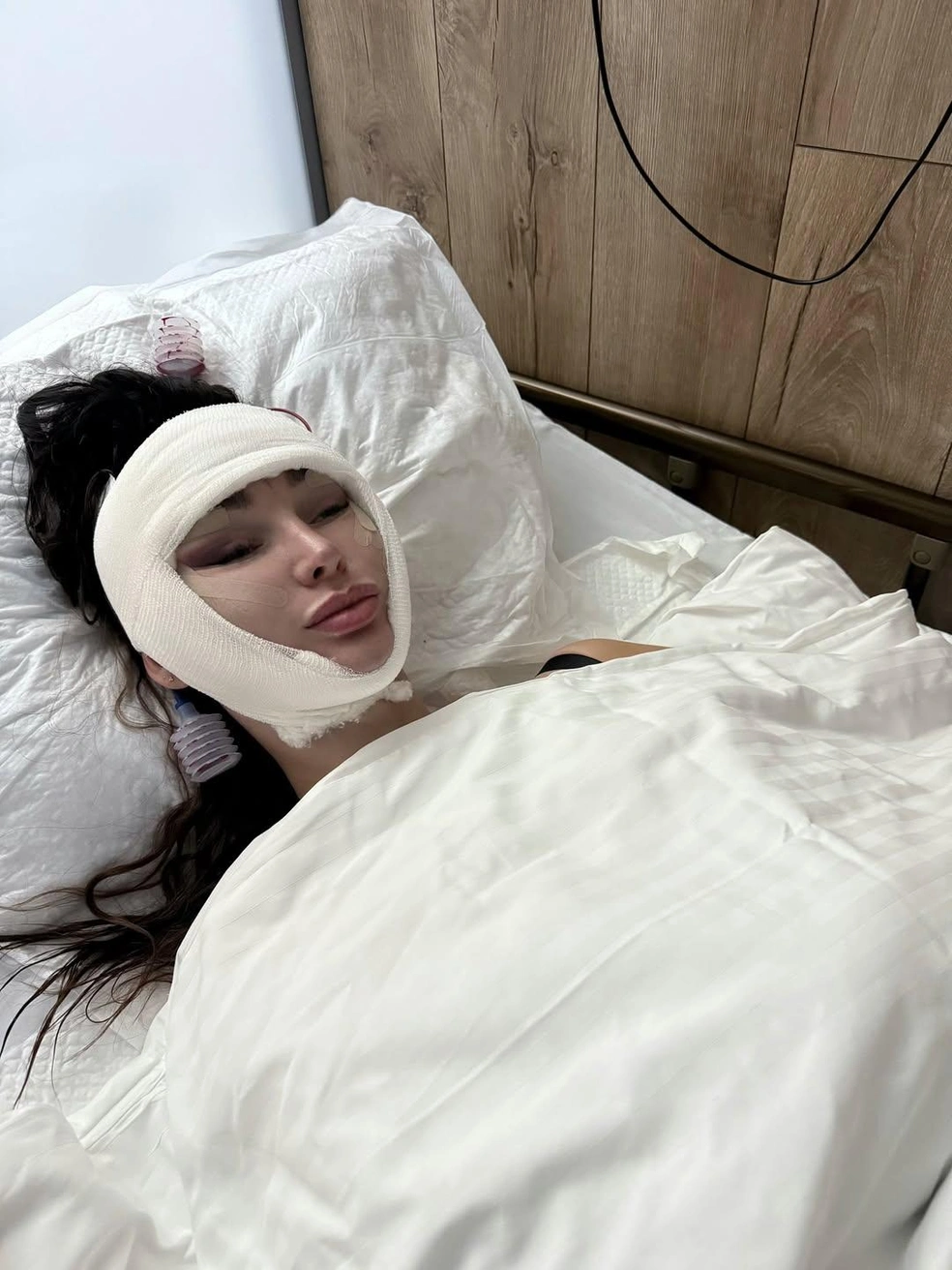 По словам Сильваши, в первые сутки «сохраняются болевые ощущения в области лба и затылка, но всё достаточно терпимо» | Источник: silvashi_officiel / Instagram (экстремистская организация, деятельность запрещена на территории РФ)