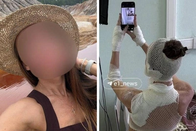 Екатеринбурженка после кислотной атаки: «Я испытываю адскую боль»