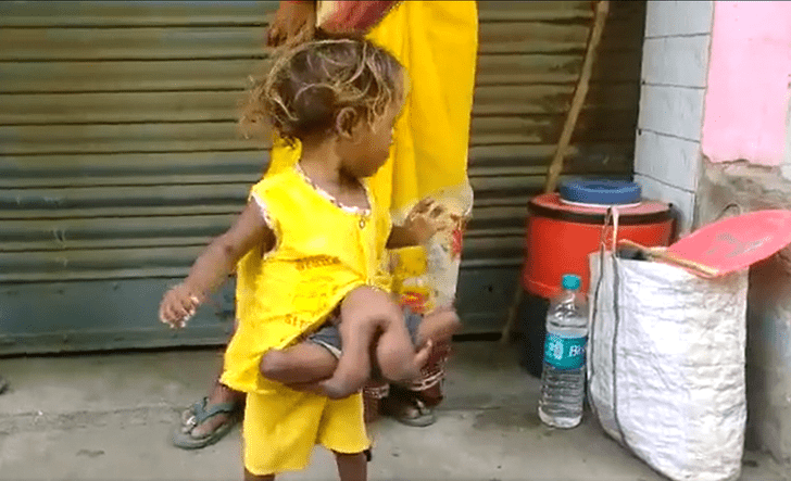 «Девочка-паук» из Индии больше не может жить с 8 конечностями и умоляет об операции