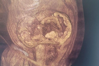 Грыжу 35x25 см удалили в Воронеже после 10 лет мучений