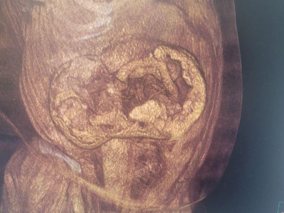 Воронежской пенсионерке удалили огромную грыжу после 10 лет