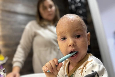 Yekaterinburg boy lives with rare skin disease ichthyosis