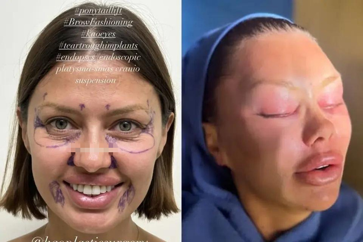 Виктория Боня до и после операции. | Instagram