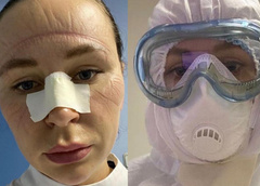 Лица со шрамами: как выглядят врачи после смены в маске