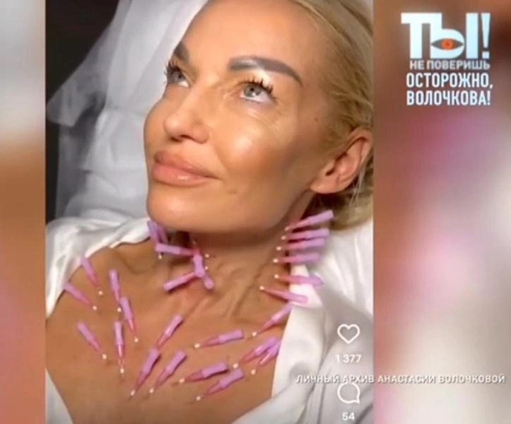 Волочкова призналась, что больше никогда не обраться к косметологу