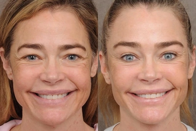 Фото Дениз Ричардс до и после привлекли клиентов хирургу