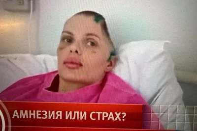 Model Angelika Tartanova Emerges from Coma After Losing Half Her Skull