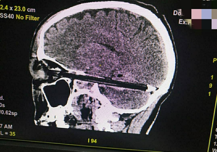 Ростовские врачи извлекли из мозга 37-летнего мужчины шариковую ручку