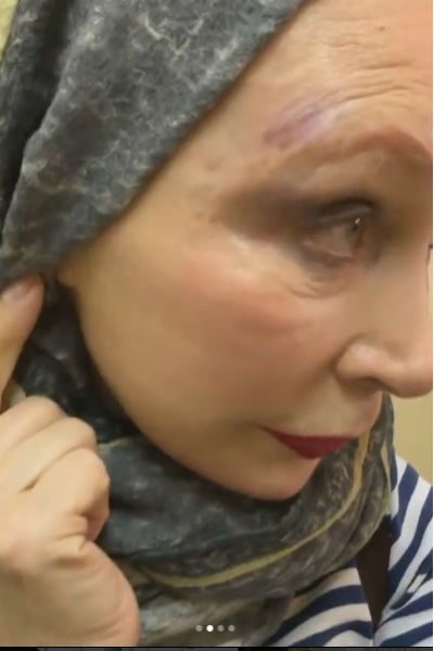 Татьяна Васильева показала гематомы на голове
