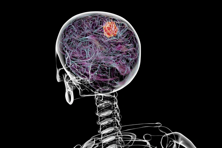 Подобраться изнутри: как в России ищут способ победить глиобластому — самый агрессивный вид рака мозга | Источник: Science Photo Library via Legion Media