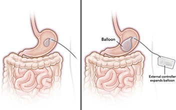 Надуется перед обедом, а потом сдуется: ученые изобрели инновационный гастробаллон для похудения