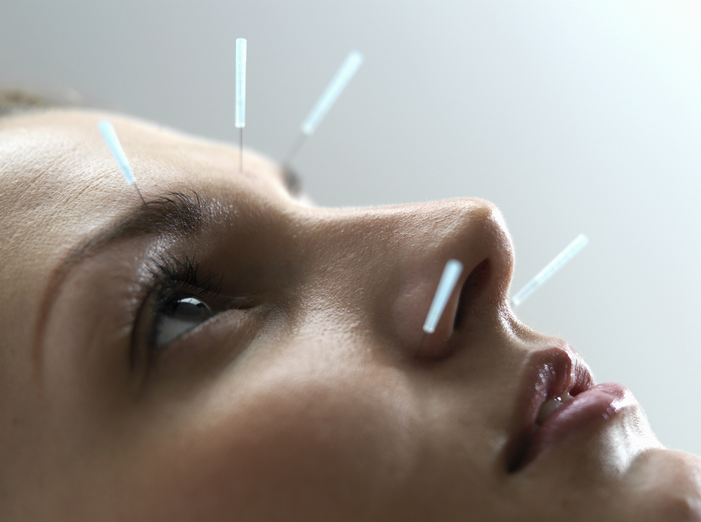 Точечное оздоровление: что нужно знать об иглоукалывании | marieclaire.ru