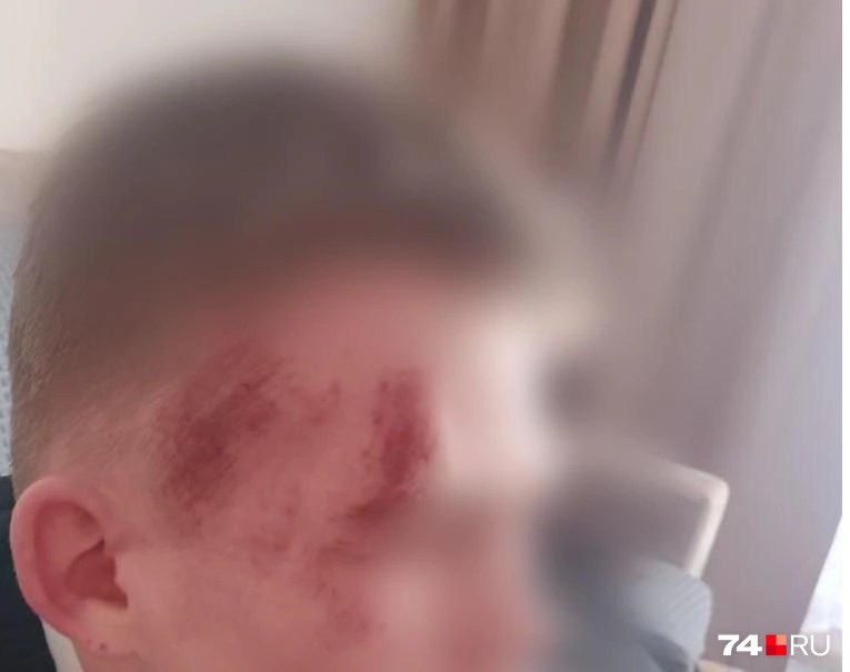У пострадавшего парня были ссадины и царапины на лице и под одеждой | Источник: читатель 74.RU