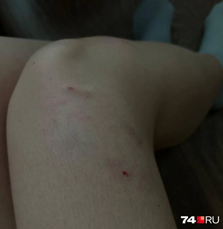 Собаки укусили девушку за ногу | Источник: читатель 74.RU