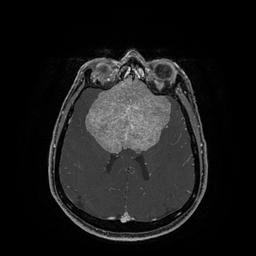 Так выглядела опухоль | Источник: Центр Мешалкина