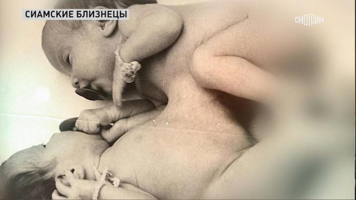 Делит сына с сестрой и мечтает о втором ребенке: как живет сиамский близнец из Челябинска, ставшая мамой