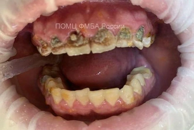 Dentist explains how energy drinks nearly cost student his teeth