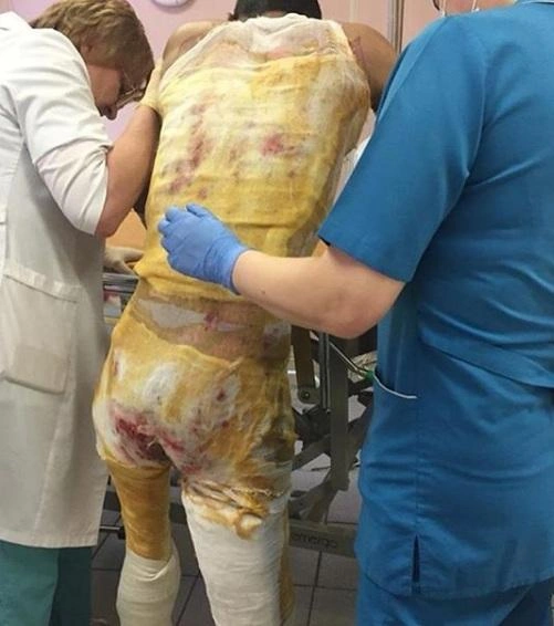 Студент получил сильные ожоги | Источник: друзья пострадавшего