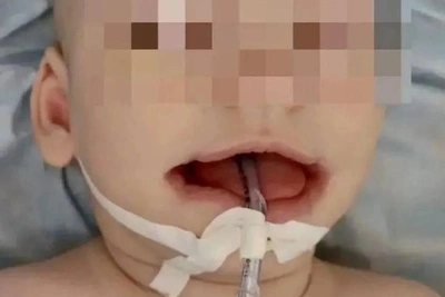В Уфе младенцу с редкой патологией лица провели операцию