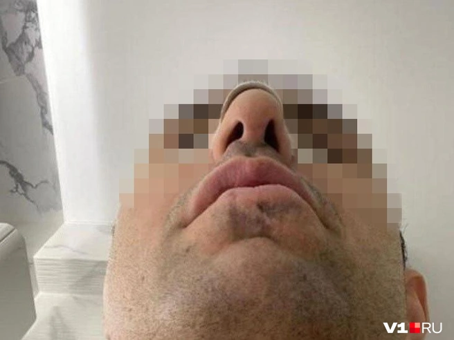 Так выглядел нос после первой операции | Источник: Артем Кулиев, Юрий Скулыбердин / V1.RU