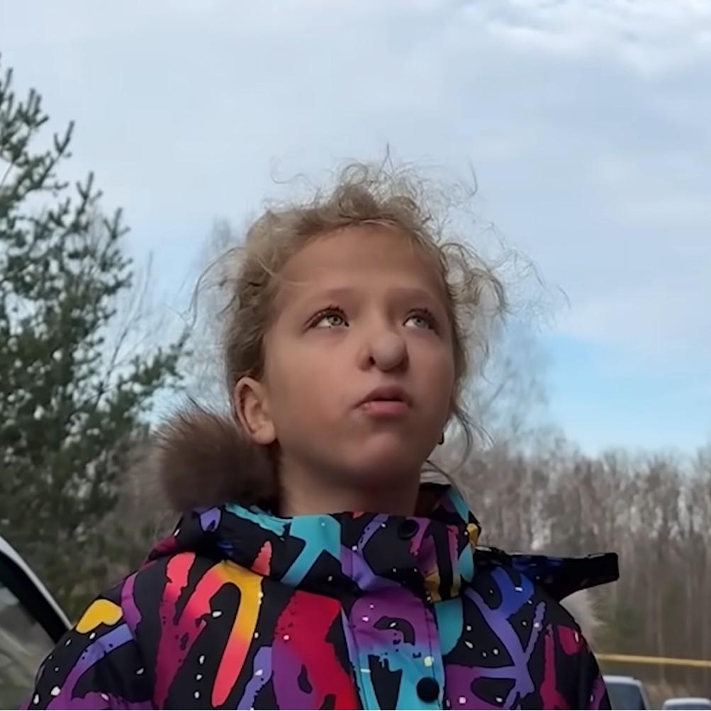 Бинты сняли, нос заживает: 11-летняя Варя после пластики начала новую жизнь