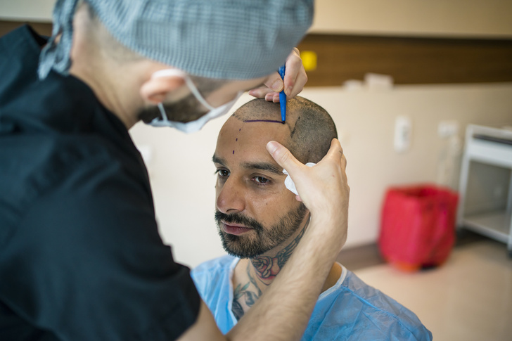 200 тысяч мужчин в год: почему Турция считается лидером по пересадке волос?