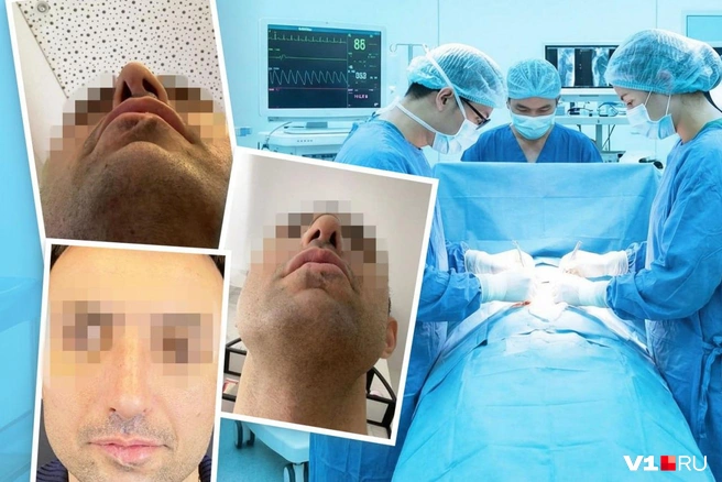 Носу мужчины пришлось переносить несколько неудачных операций | Источник: Юрий Скулыбердин, Артем Кулиев / V1.RU