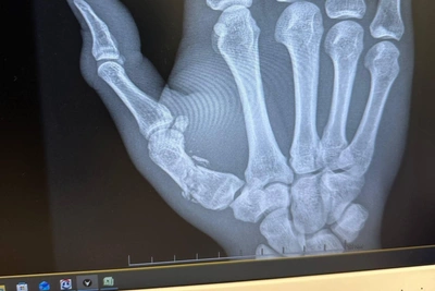 UFC fighter Andrey Pulyaev broke hand, continued to fight