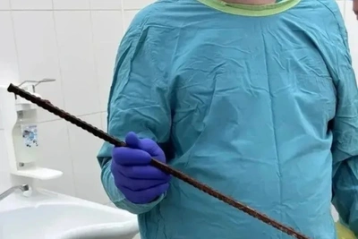 Хирурги Ижевска извлекли арматуру из груди пациента