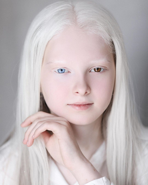 11-летняя девочка-альбинос с гетерохромией из Чечни поражает своей волшебной красотой