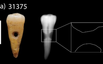 В Турции найдены украшения из человеческих зубов