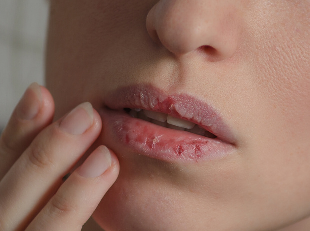 Фото №3 - О каких проблемах со здоровьем говорит сухая кожа губ