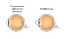 Что делать, если вам диагностировали кератоконус