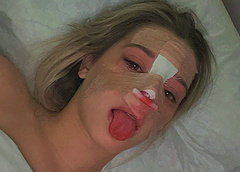 «Очень больно!» Девушка Дани Милохина, тиктокерша Юля Гаврилина сделала ринопластику – фото