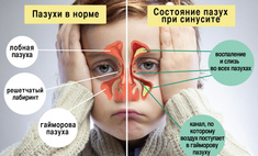Гайморит у детей: признаки, симптомы и правильное лечение