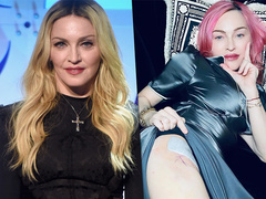 Бедро со шрамом: Мадонна испугала фолловеров швами на теле