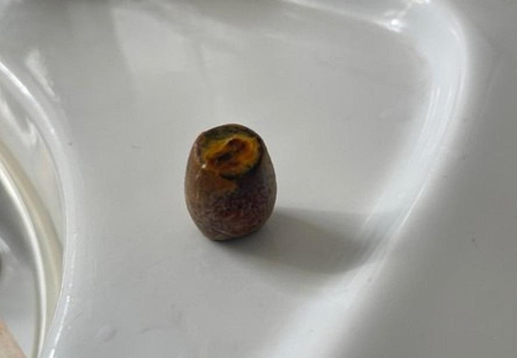 В Подмосковье врачи достали у женщины холестериновый камень в форме бочонка лото