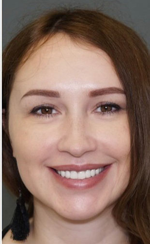 Как меняют улыбку виниры: 20 фото до и после