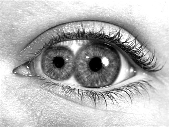 Pupula duplex (������� ������