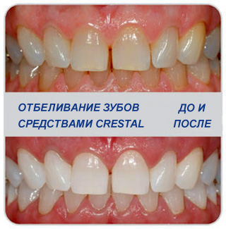 ��� � �������. Crestal - �������� ��� ����������� ����� � �������� ��������. - ����� - 7.