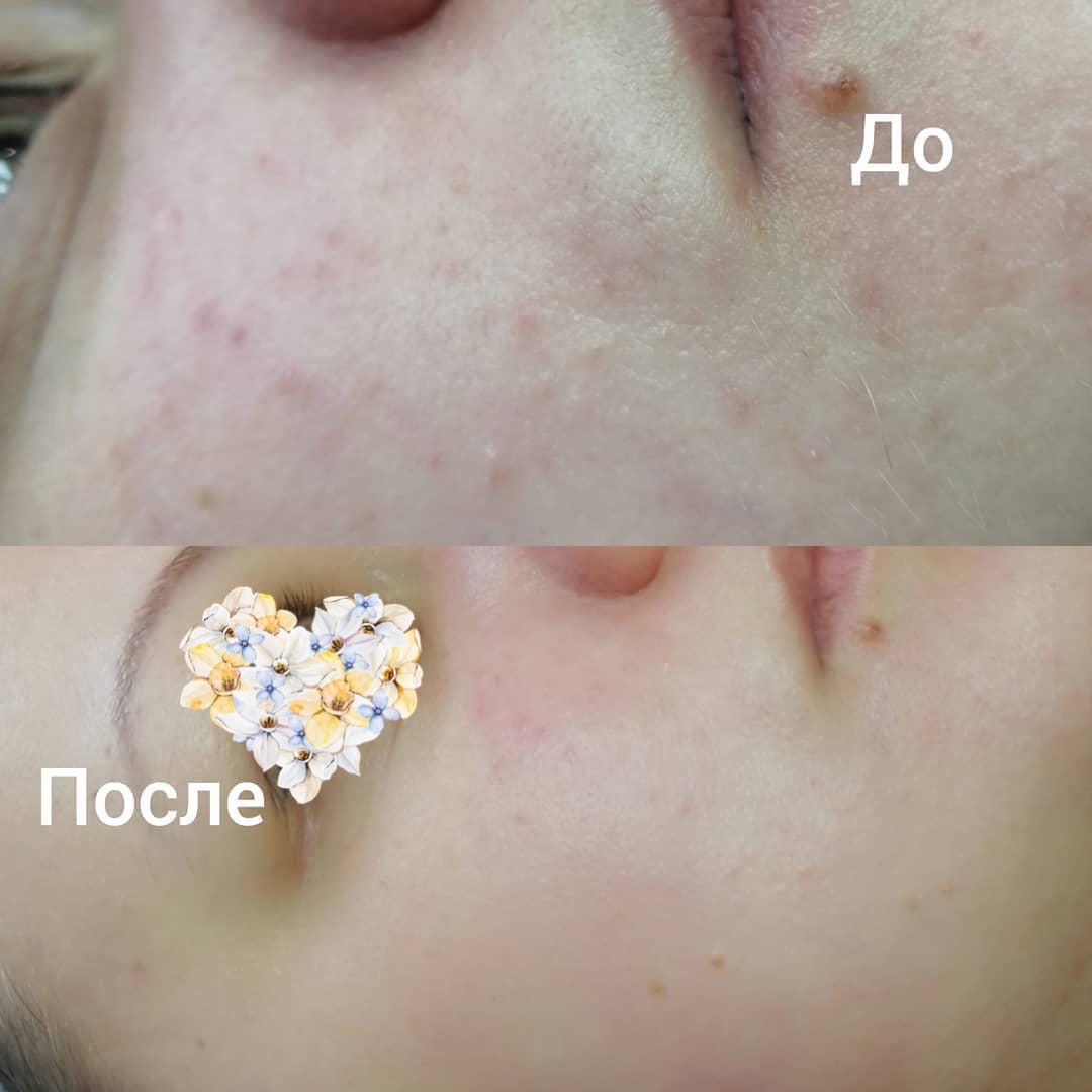 �������� ��������� ��� ����� ������ ���������! ��������������� ������� ��� ������� AR Comfort peel 20% ARKADIA   