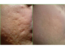 6361163.Dermaroller before after photo 4 acne scar treatment botonics.jpg